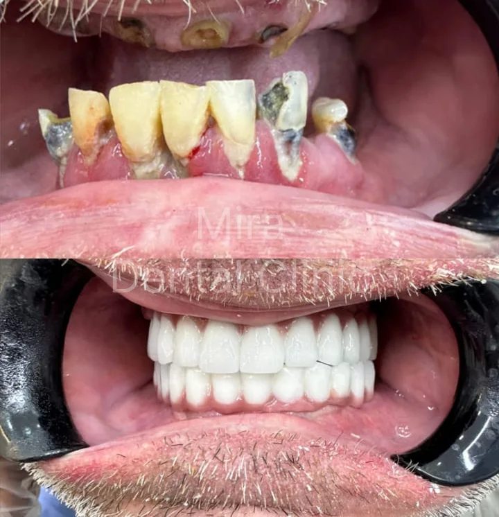 Before and after: severely worn and decayed upper and lower teeth restored to a full white smile