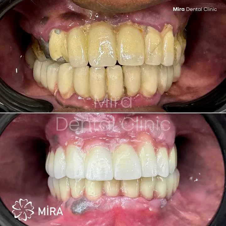 Before and after: discoloured, uneven teeth replaced with matched full-arch crowns