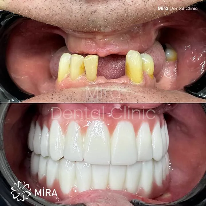 Before and after: an upper arch with most teeth missing, rebuilt into a complete smile