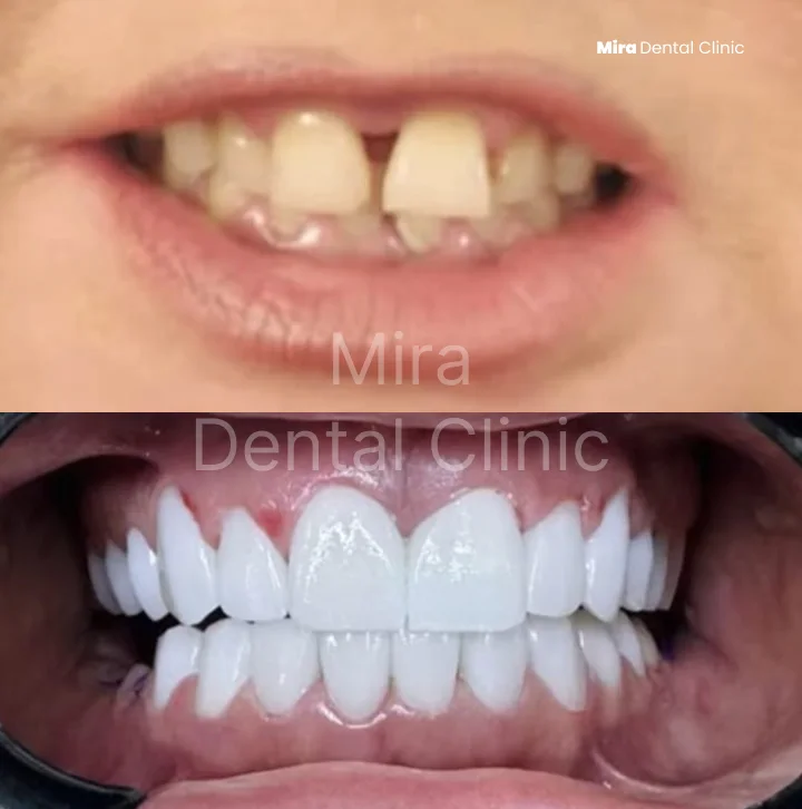 Before and after: gapped and undersized front teeth reshaped into an even smile