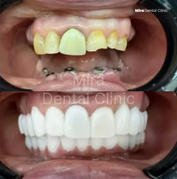Before and after: failing old crowns and missing teeth replaced with a full new smile